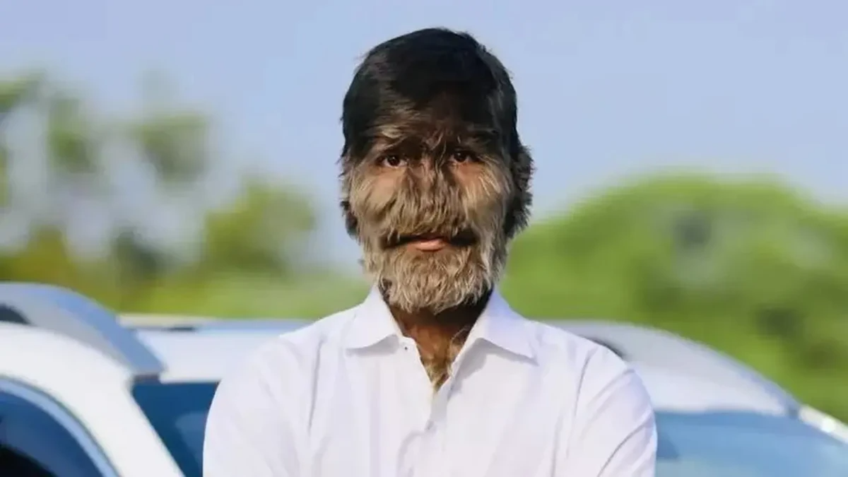 Jovem da Índia entra para o Guinness World Records como dono do rosto mais peludo do mundo